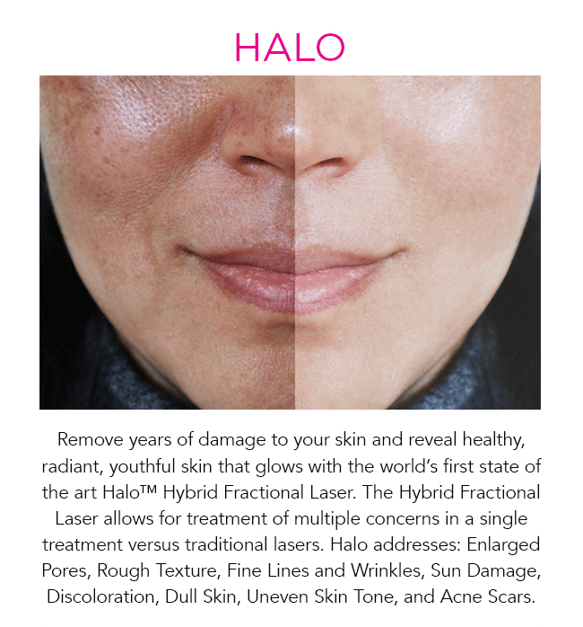Remove years of damage to your skin and reveal healthy, radiant, youthful skin that glows with the worlds first state of the art Halo Hybrid Fractional Laser. The Hybrid Fractional Laser allows for treatment of multiple concerns in a single treatment versus traditional lasers. Halo addresses: Enlarged Pores, Rough Texture, Fine Lines and Wrinkles, Sun Damage, Discoloration, Dull Skin, Uneven Skin Tone, and Acne Scars.