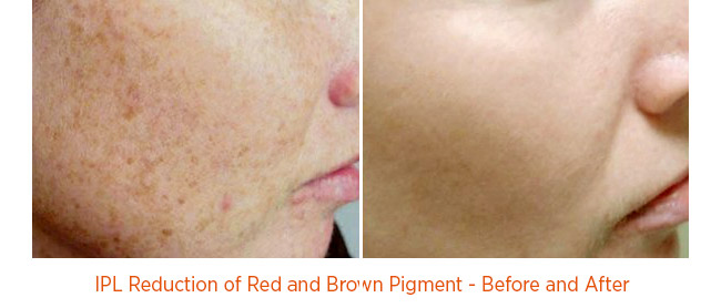 IPL Reduction of Red and Brown Pigment - Before and After