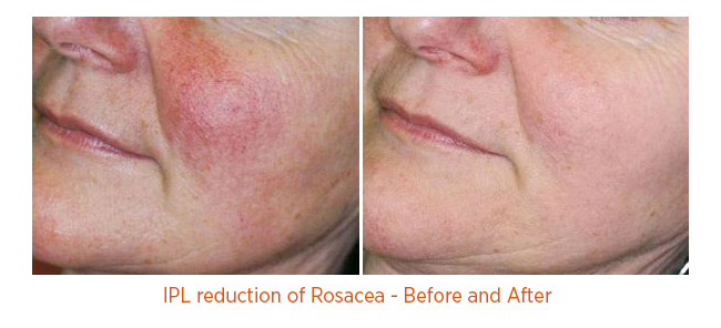 IPL reduction of Rosacea - Before and After