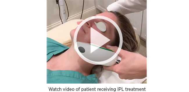 Watch video of patient receiving IPL treatment