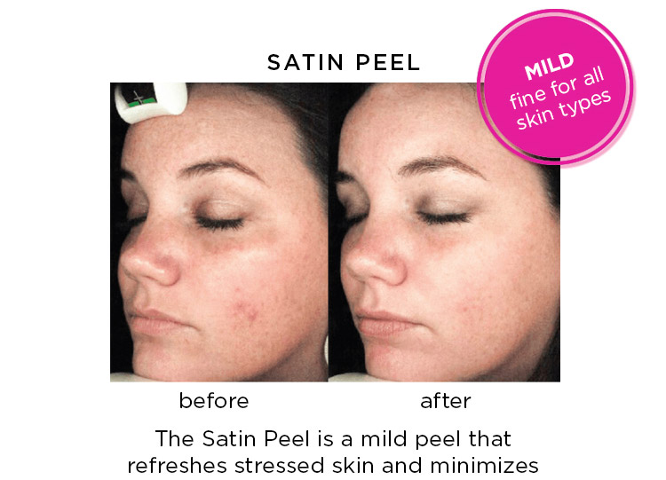 The Satin Peel is a mild peel that refreshes stressed skin and minimizes the appearance of pores, fine lines and wrinkles.