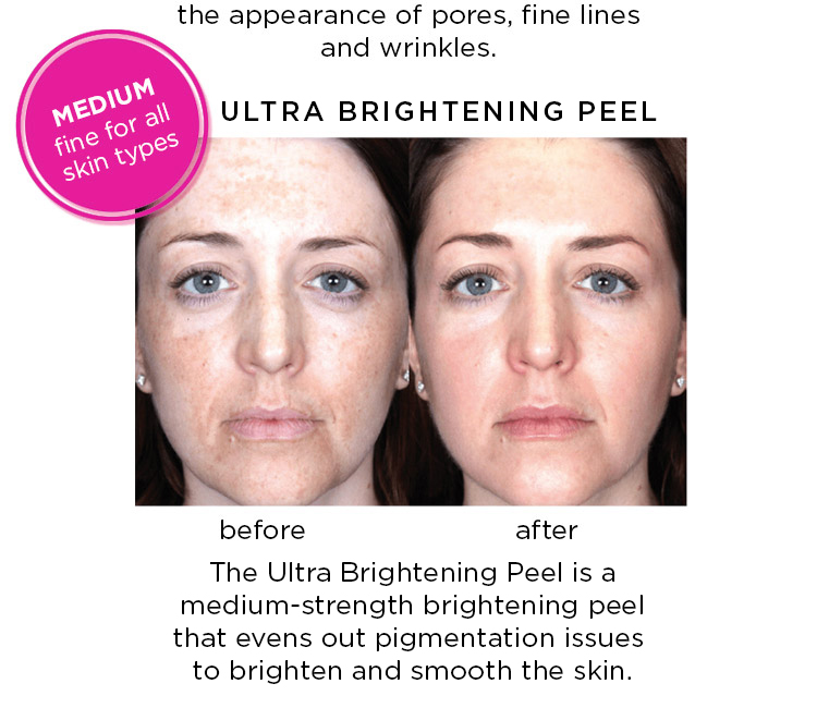 he Ultra Brightening Peel is a medium-strength brightening peel that evens out pigmentation issues to brighten and smooth the skin.