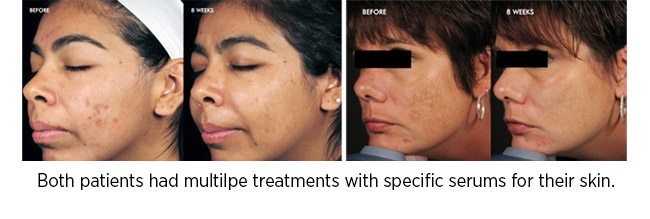 Both patients had multilpe treatments with specific serums for their skin.